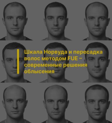 Шкала Норвуда и пересадка волос методом FUE – современные решения облысения