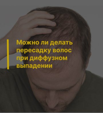 Можно ли делать пересадку волос при диффузном выпадении