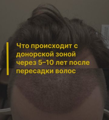 Что происходит с донорской зоной через 5–10 лет после пересадки волос