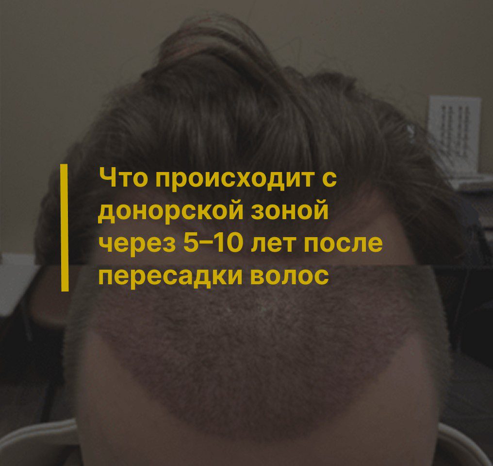 Что происходит с донорской зоной через 5–10 лет после пересадки волос
