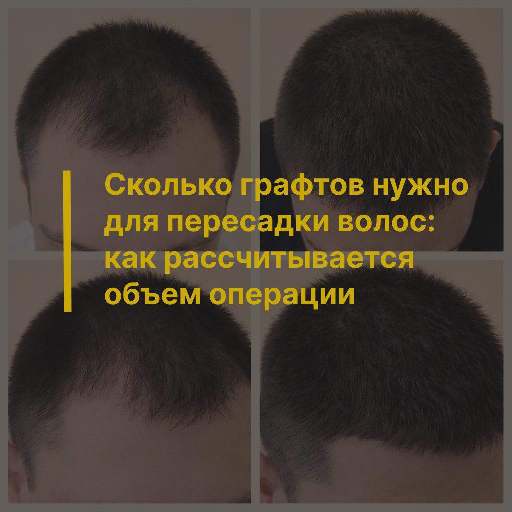 Сколько графтов нужно для пересадки волос в Екатеринбурге: как рассчитывается объем операции