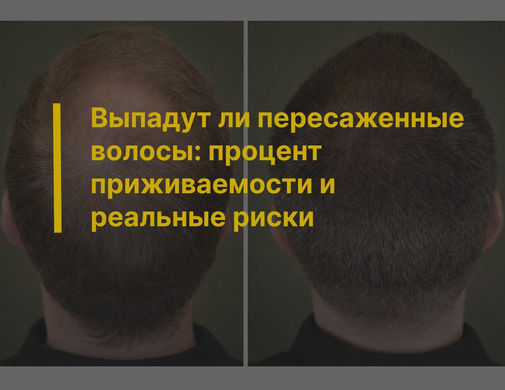 Выпадут ли пересаженные волосы: процент приживаемости и реальные риски