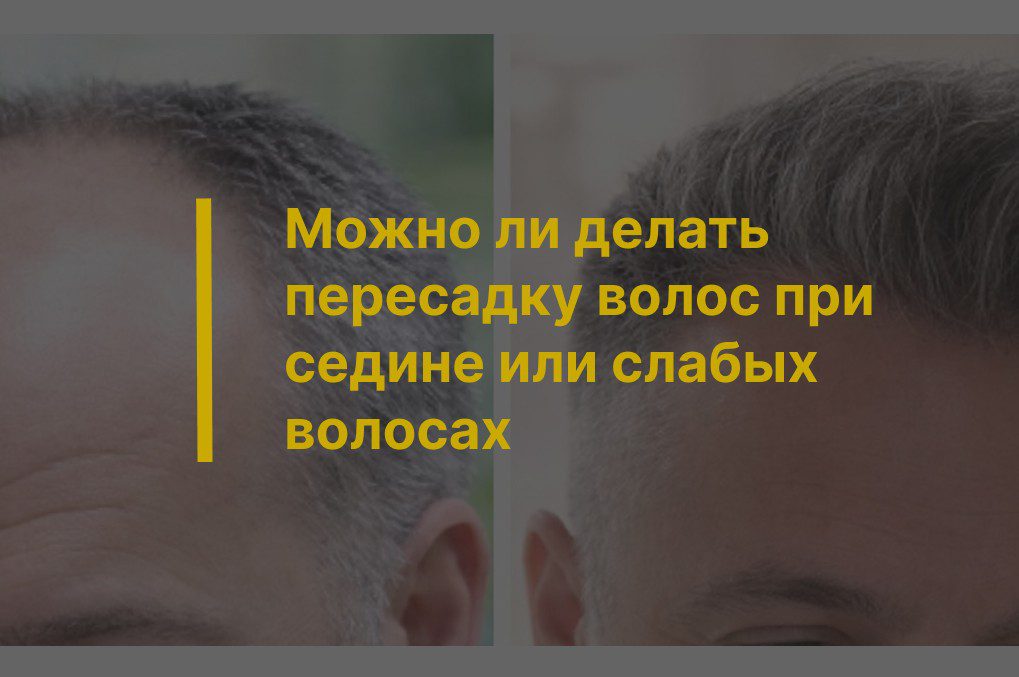 Можно ли делать пересадку волос при седине или слабых волосах