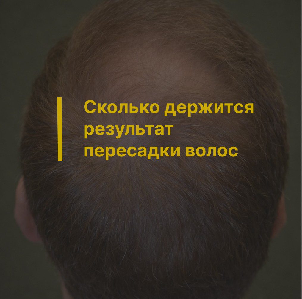 Сколько держится результат пересадки волос