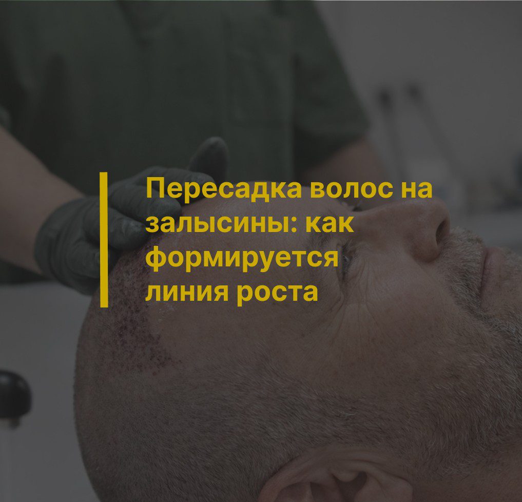 Пересадка волос на залысины: как формируется линия роста