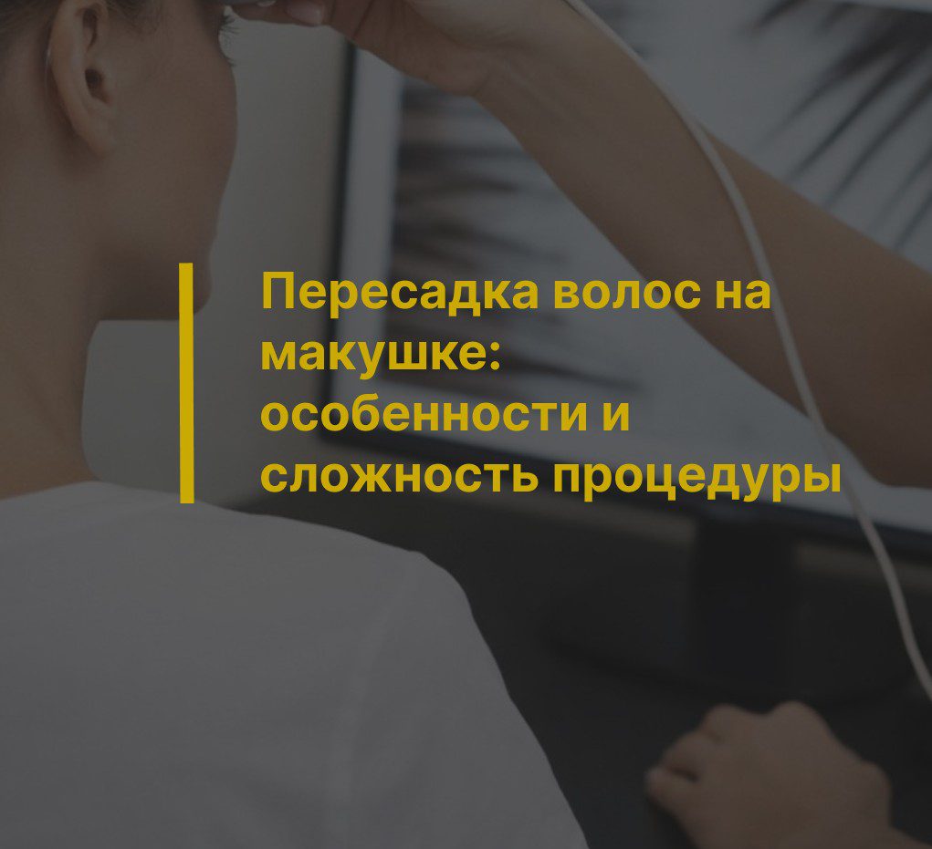 Пересадка волос на макушке: особенности и сложность процедуры