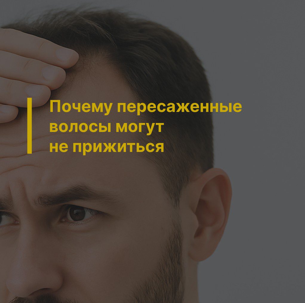 Почему пересаженные волосы могут не прижиться