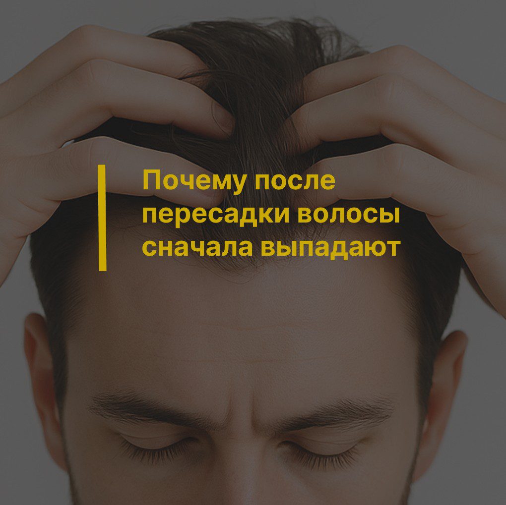 Почему после пересадки волосы сначала выпадают: нормально ли это