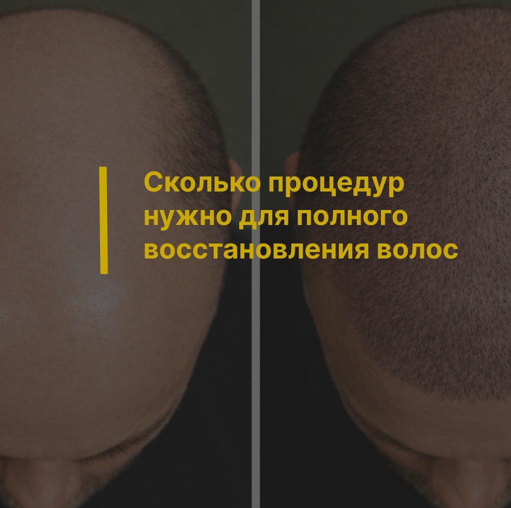 Сколько процедур нужно для полного восстановления волос: один этап или несколько