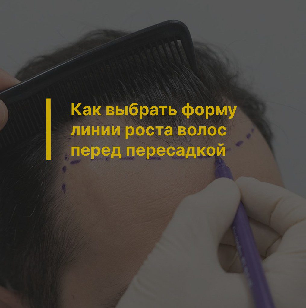 Как выбрать форму линии роста волос перед пересадкой