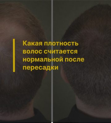 Какая плотность волос считается нормальной после пересадки