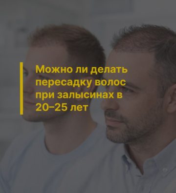 Можно ли делать пересадку волос при залысинах в 20–25 лет