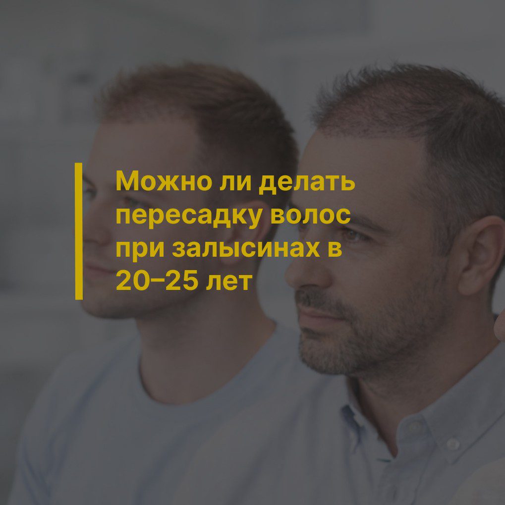 Можно ли делать пересадку волос при залысинах в 20–25 лет