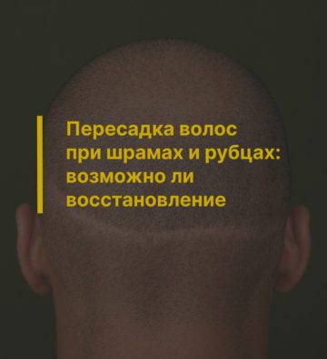 Пересадка волос при шрамах и рубцах: возможно ли восстановление