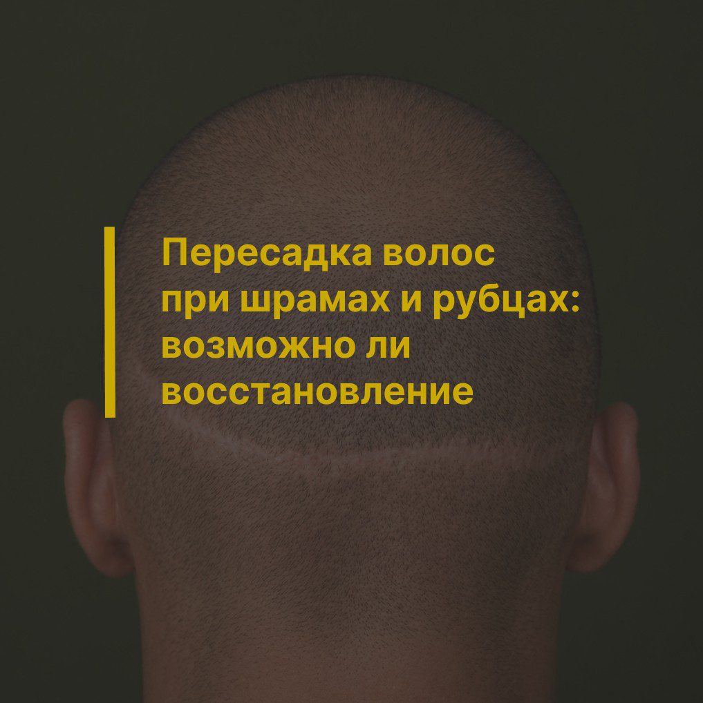 Пересадка волос при шрамах и рубцах: возможно ли восстановление